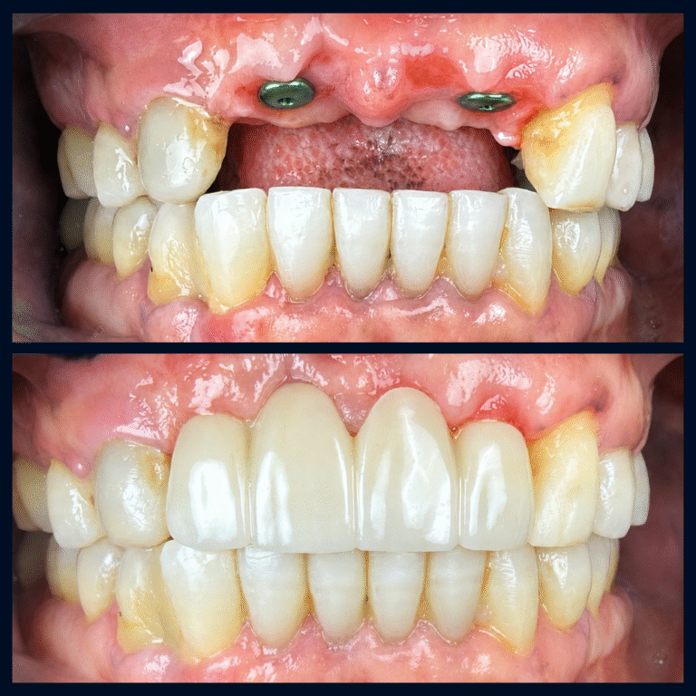 Before and after implant bridge treatment following extractions and bone grafting to restore smile function and aesthetics.