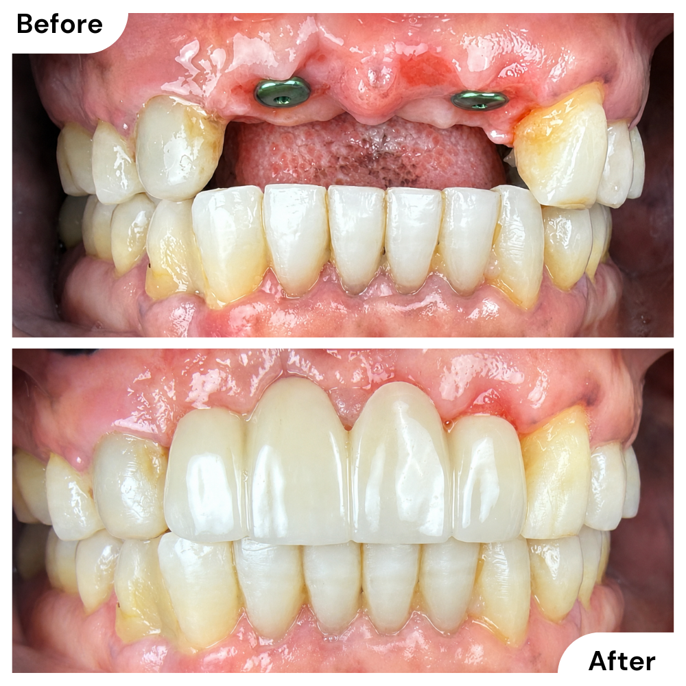 Before and after implant-supported bridge treatment at Q Smiles Dentistry in North Miami Beach