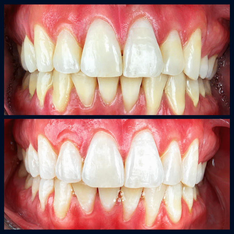Before and after professional teeth whitening showing improved tooth brightness and a cleaner smile.