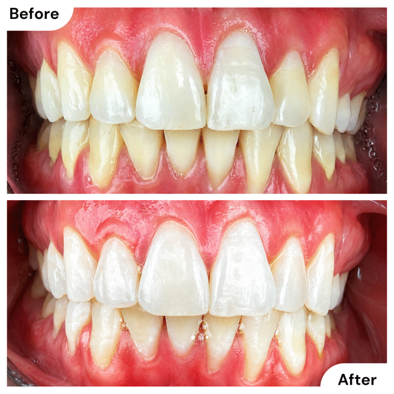 Before and after professional teeth whitening showing improved tooth brightness and a cleaner smile.