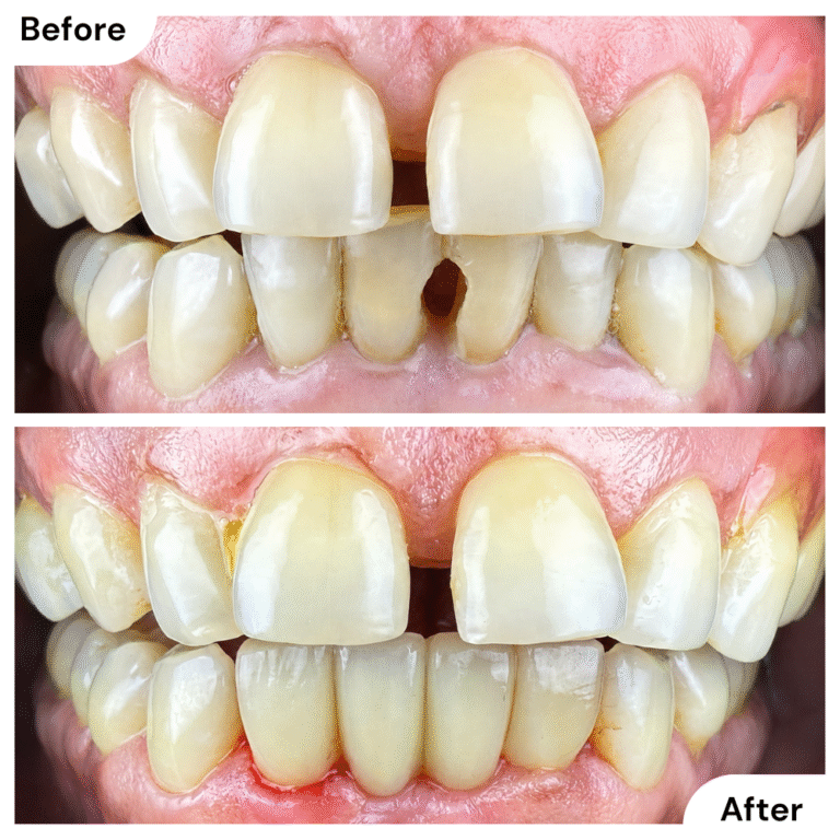 Before and after smile reconstruction with dental crowns, veneers, and a bridge to restore tooth color, shape, and function.