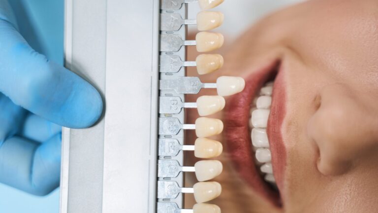 Dental Veneers at Q Smiles Dentistry in North Miami Beach