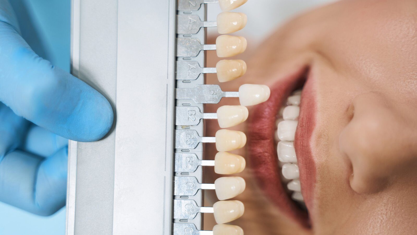 Dental Veneers at Q Smiles Dentistry in North Miami Beach
